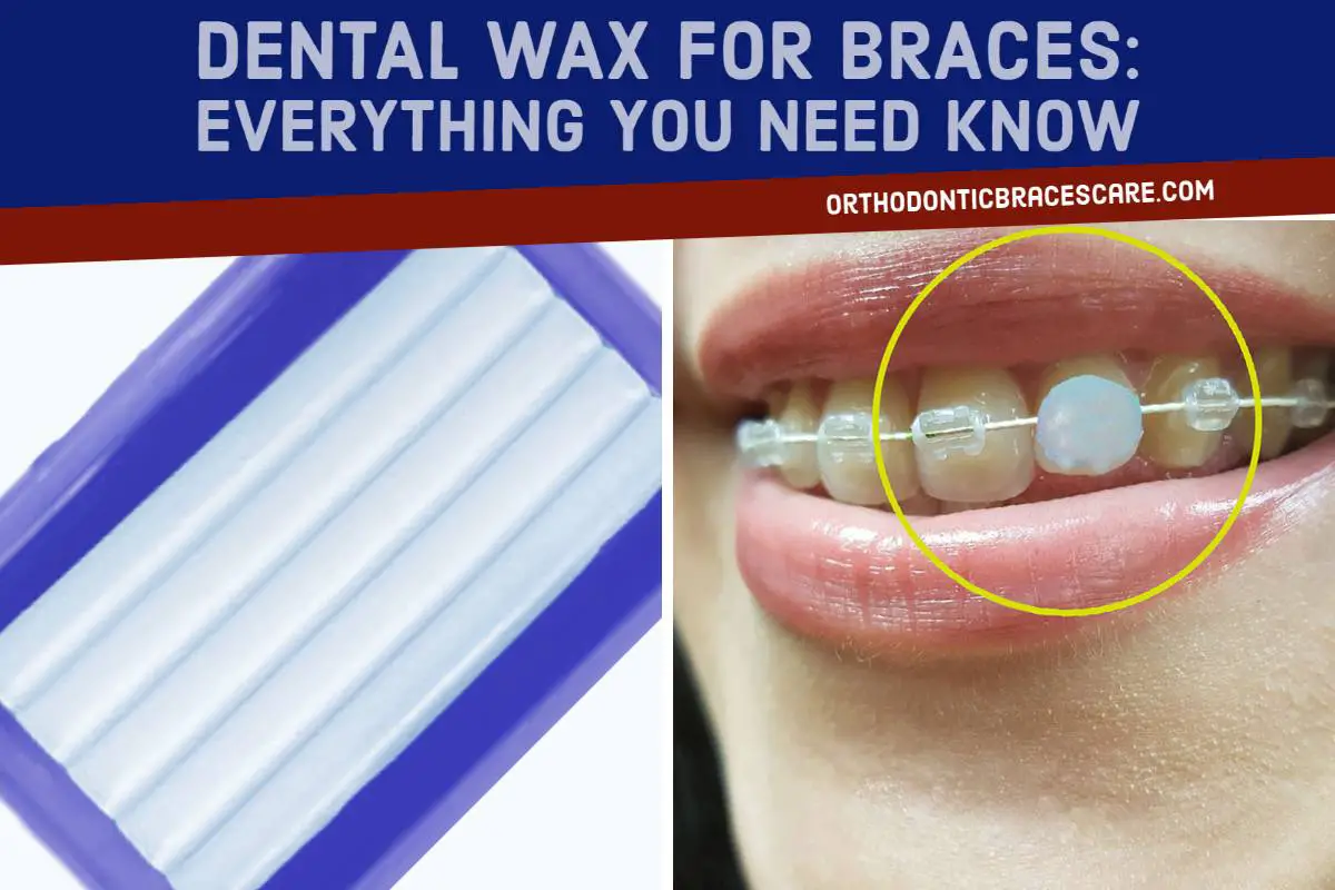 Dental-wax-for-braces.jpg