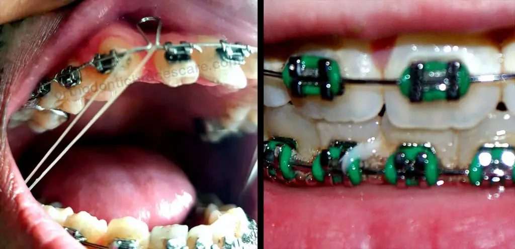 braces rubber band color wheel