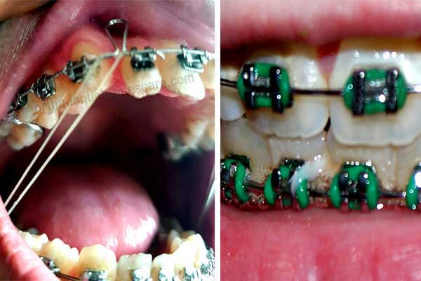 Braces Rubber Band Featured