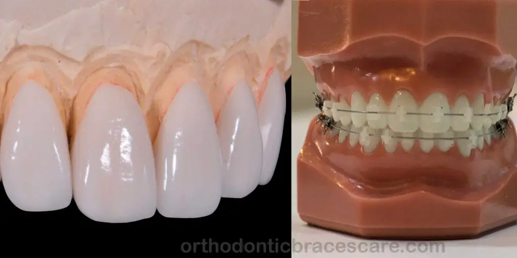 Braces With Crowns, Bridges, Veneers