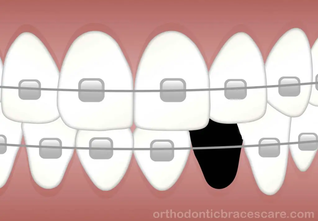Can braces fix missing tooth gap