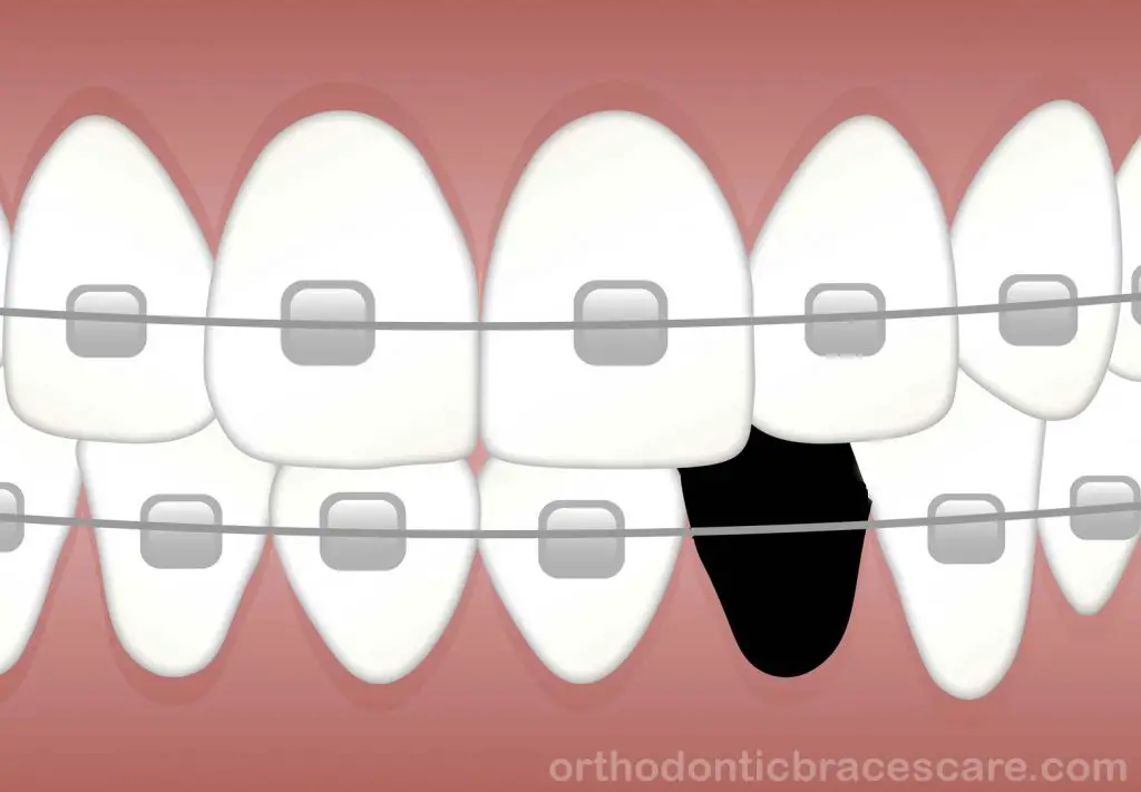 can-braces-really-close-missing-tooth-gap-orthodontic-braces-care