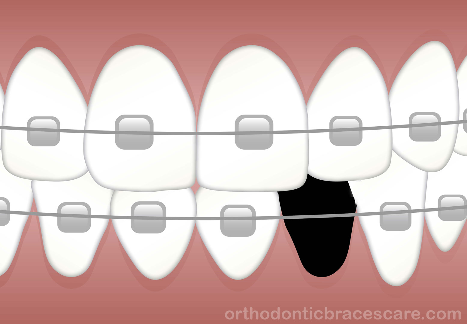 Can Braces Really Close Missing Tooth Gap Orthodontic Braces Care