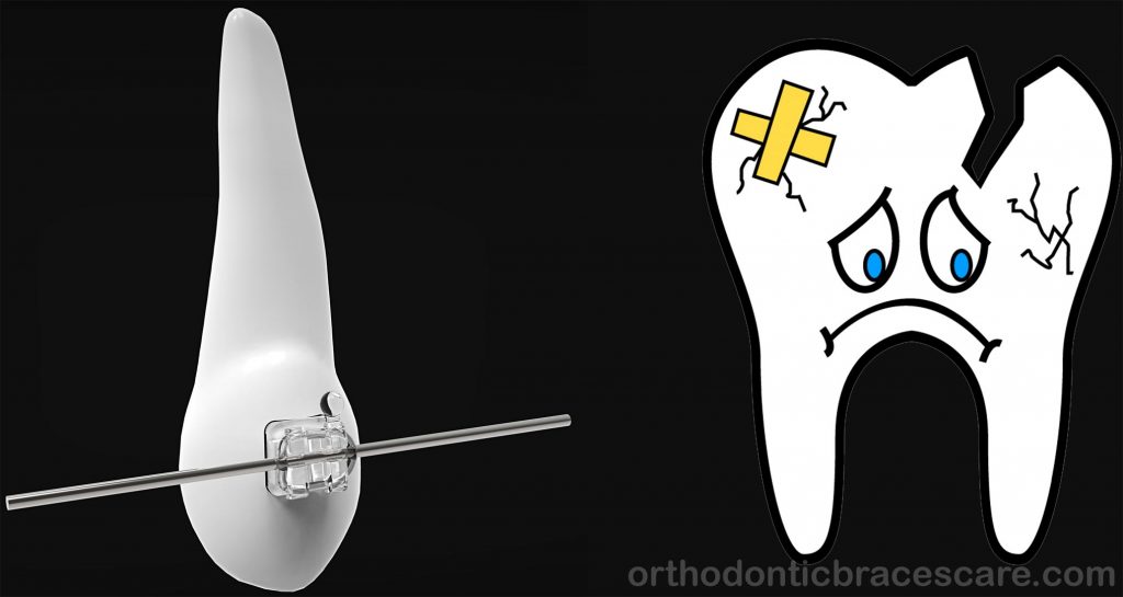 Brace and Tooth Fall Out