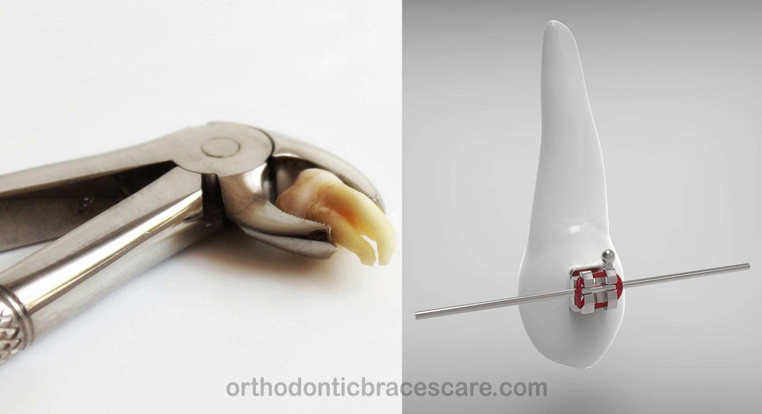 Can You Have Braces Without Removing Teeth Orthodontic Braces Care