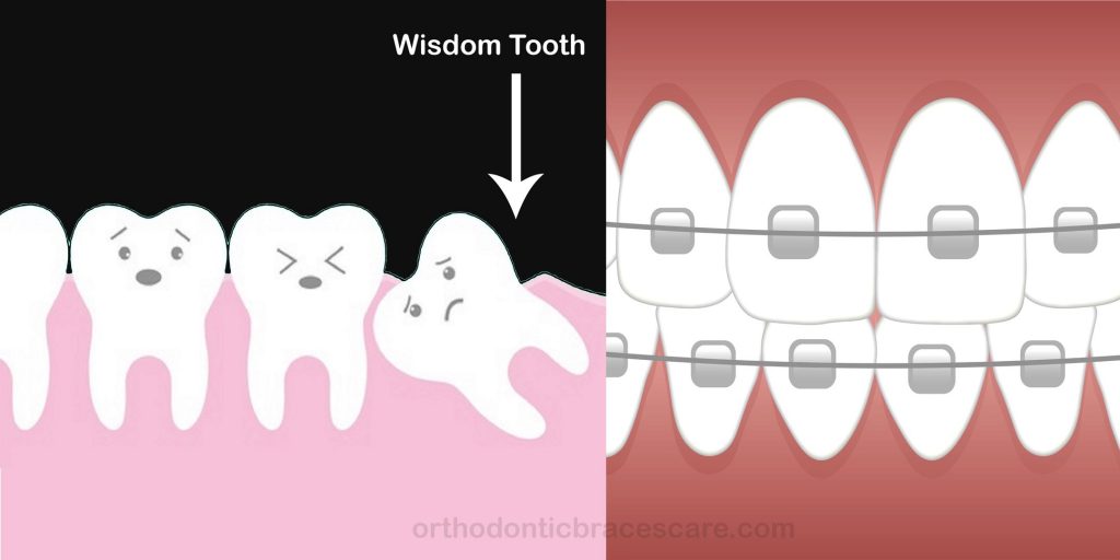 Wisdom Teeth and Braces