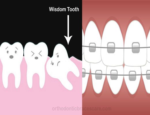 Can Braces Make Your Teeth Weak, Loose and Fall out ...