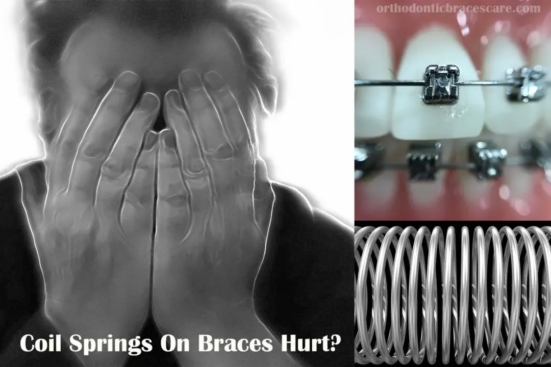 Coil Springs Braces Hurt How long, Causes, Pain Relief Tips