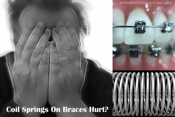 Coil Springs Braces Hurt: How long, Causes, Pain Relief Tips