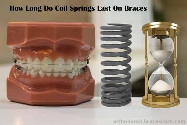 How Long Do Coil Springs Braces Last