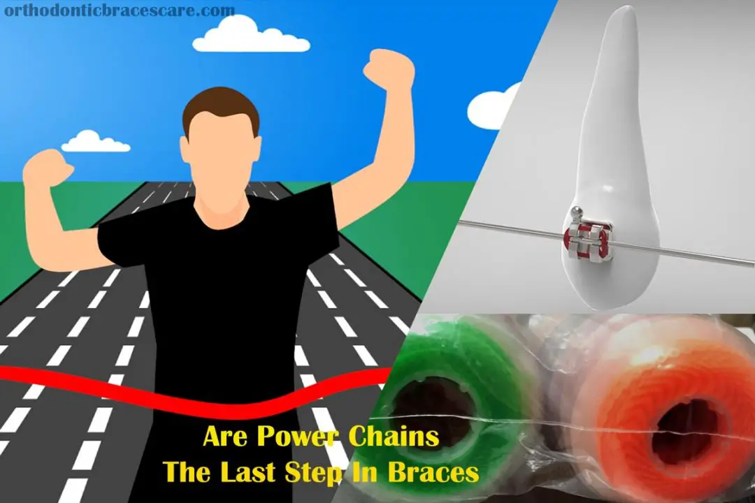 Are Power Chains Actually The Last Step In Braces Orthodontic Braces Care