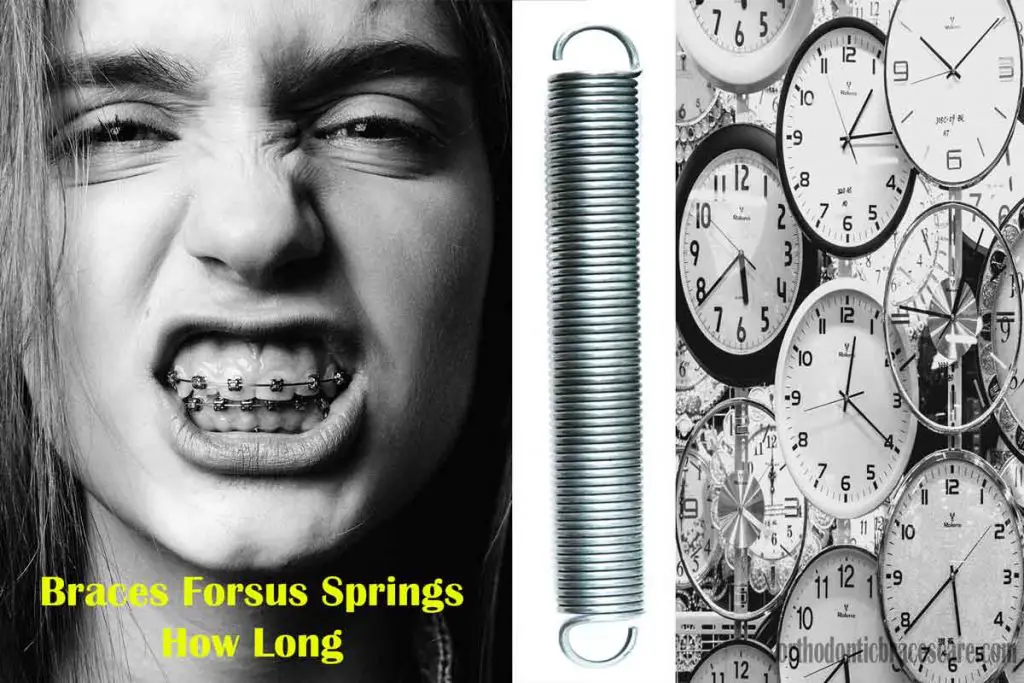 how long do you wear braces forsus springs