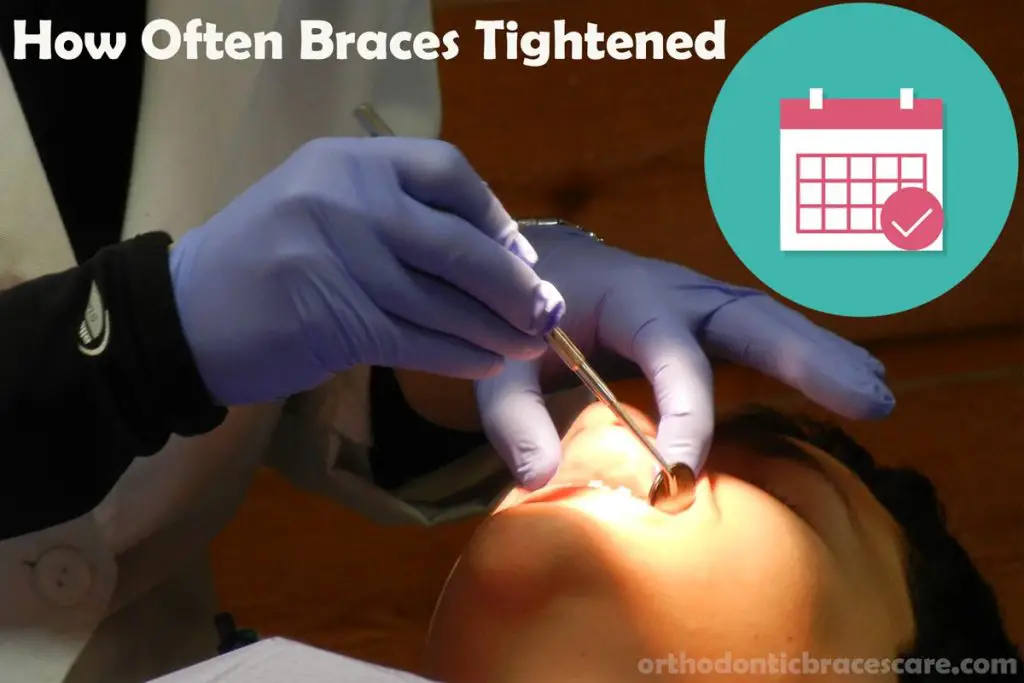 How Often Do You Have To Get Your Braces Tightened ...