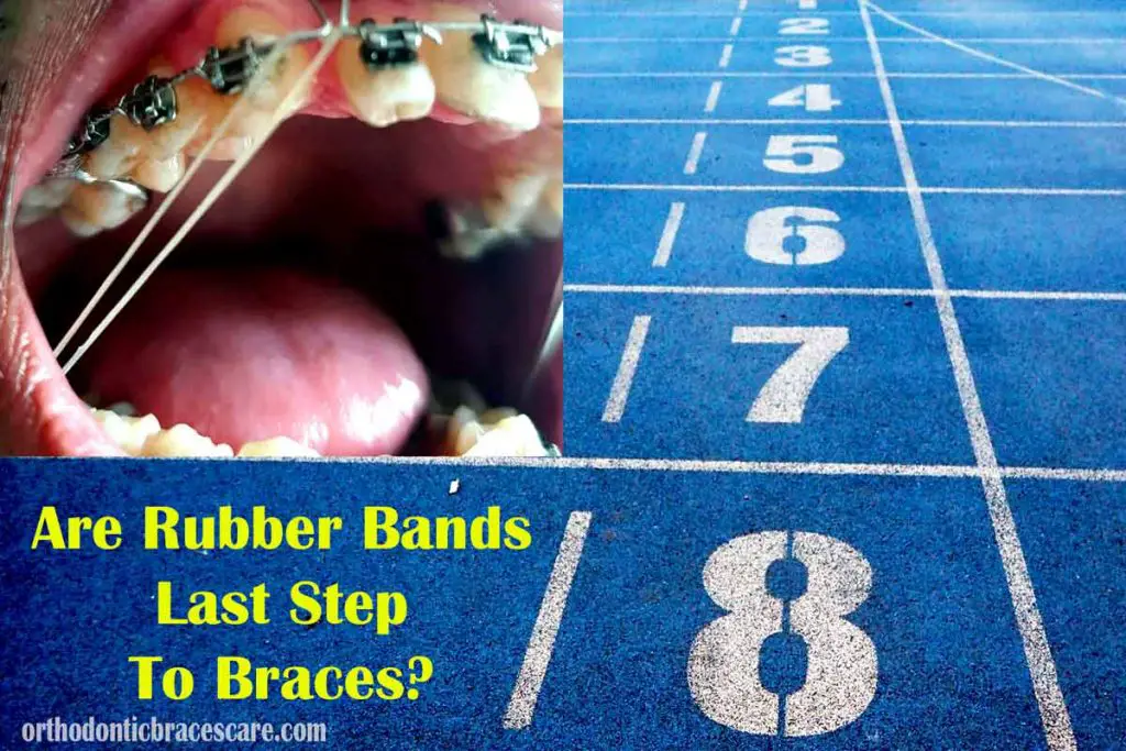 Rubber Bands Last Step To Braces