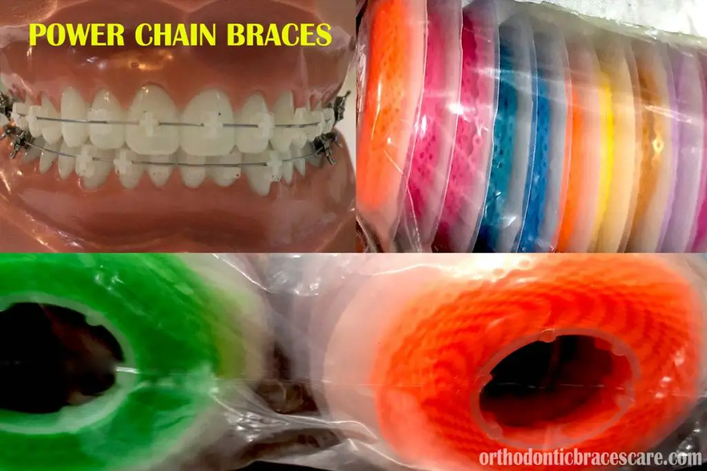 Power chains for braces: Colors, purpose and types