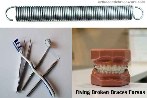 braces broken forsus spring