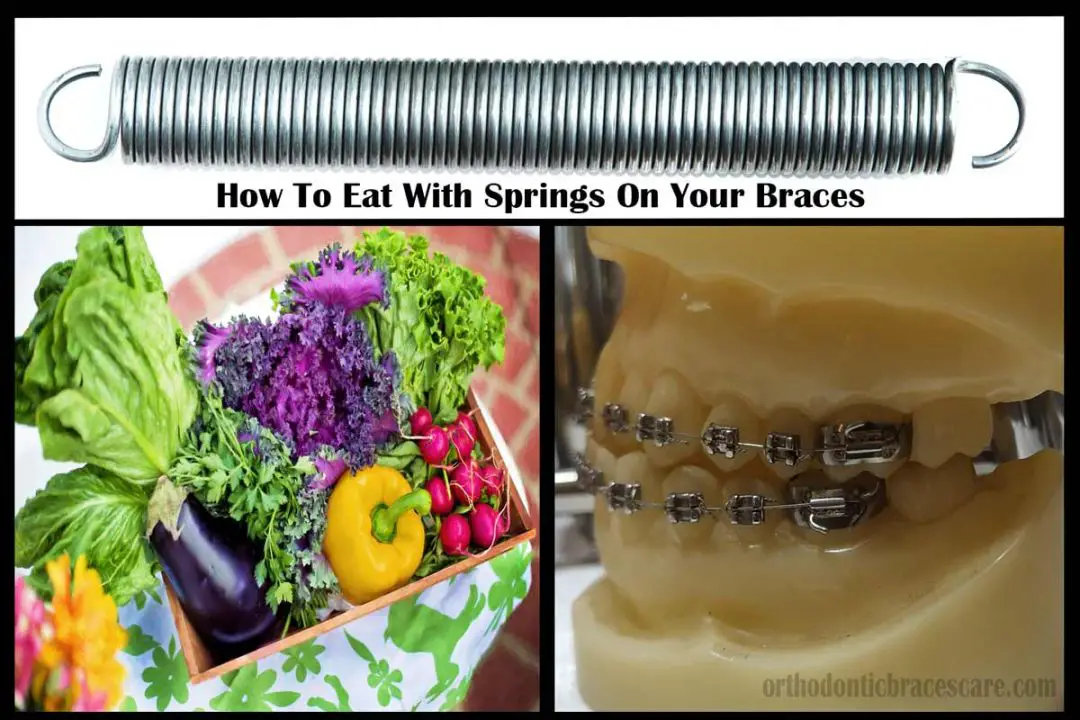 How To Eat With Springs On Your Braces Orthodontic Braces Care