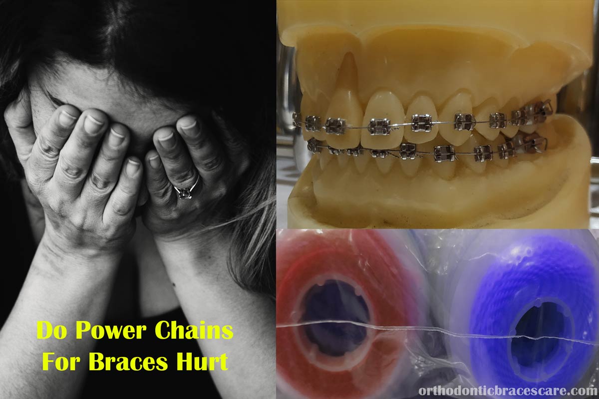 power chain braces hurt