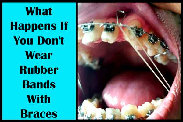 What Happens If You Don't Wear Rubber Bands With Braces