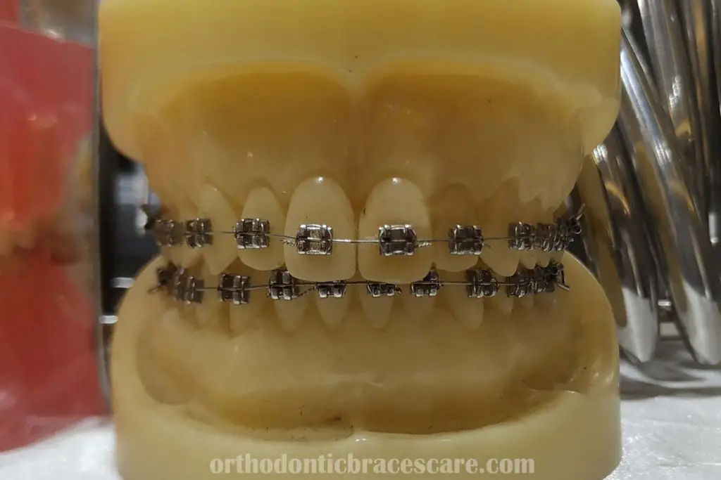 Teeth Turning Yellow With Braces