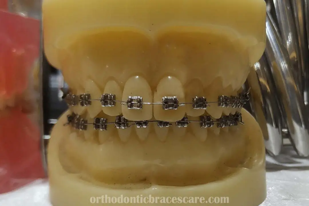 10 Reasons Why Your Teeth Turn Yellow With Braces Orthodontic Braces Care