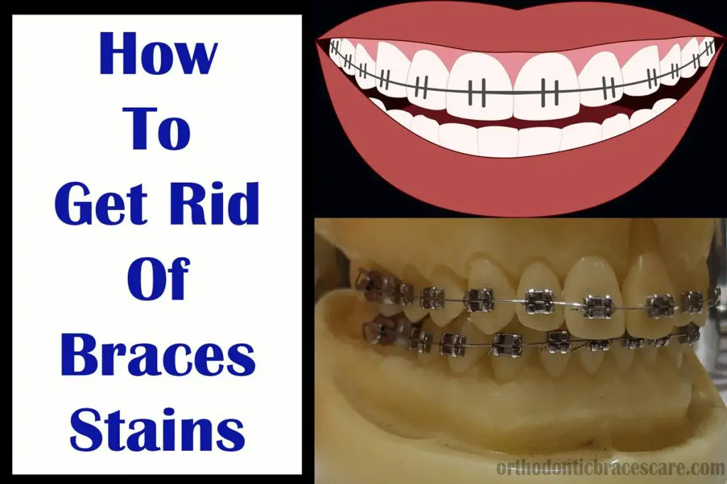 How to get rid of braces stains