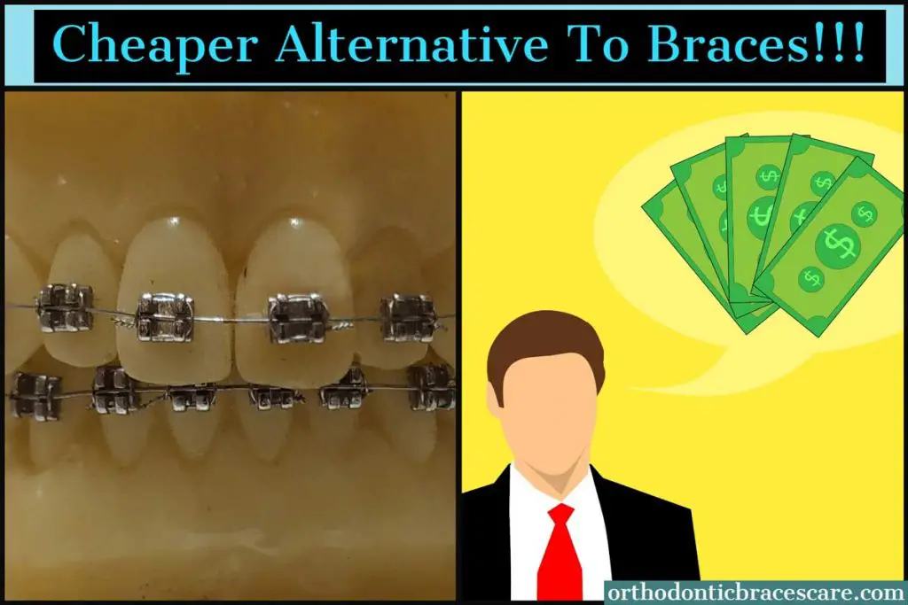 Cheaper Alternatives To Braces