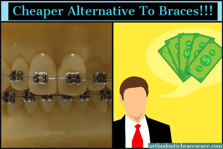 Is There A Cheaper Alternative To Braces Orthodontic Braces Care
