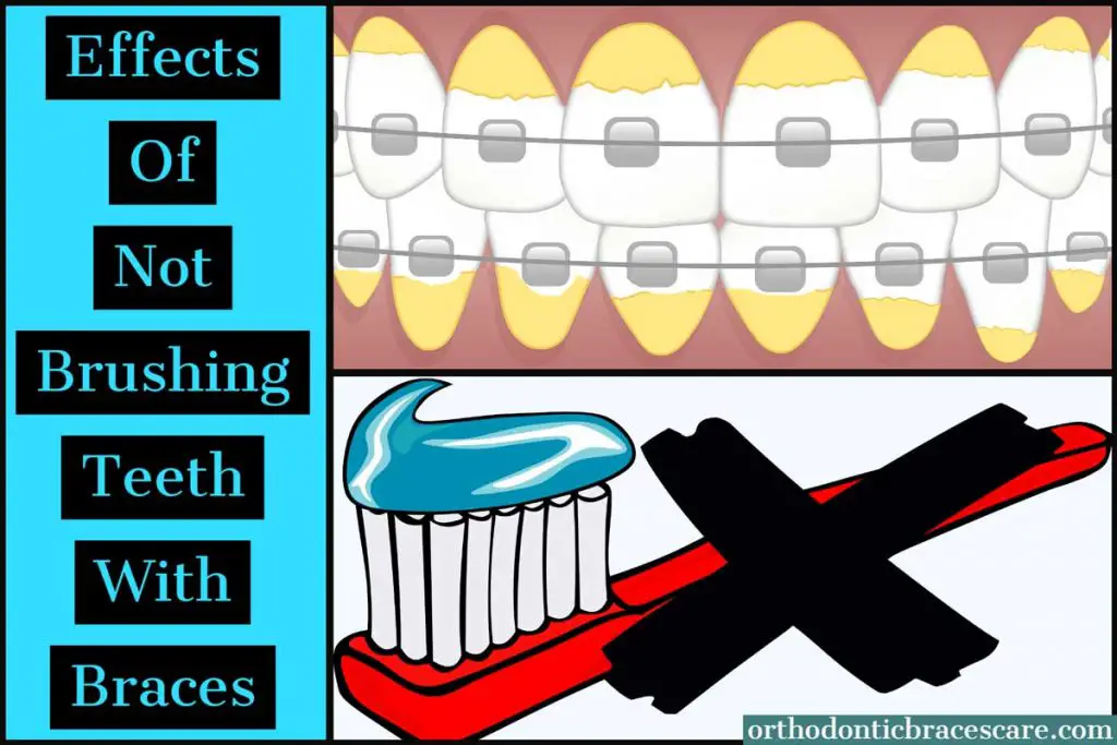 Effects Of Not Brushing Teeth With Braces