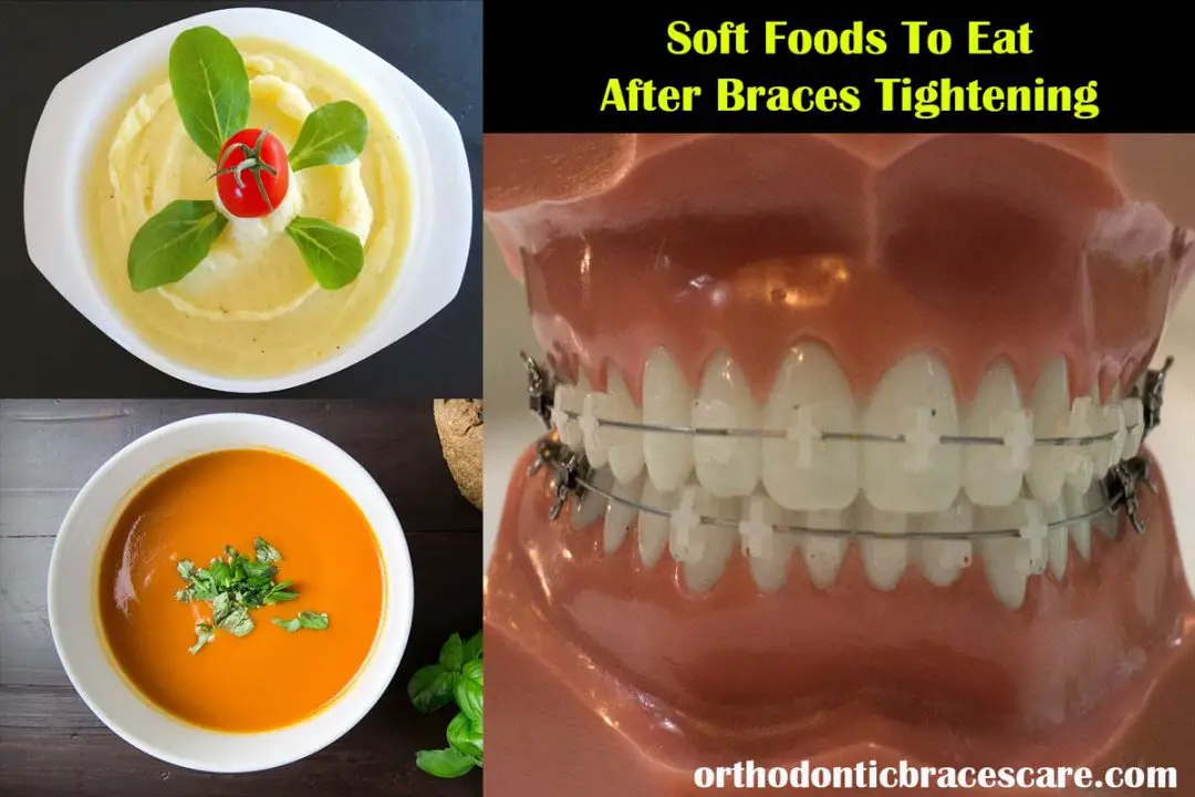Soft Foods To Eat After Braces Tightening [With List] Orthodontic Braces Care