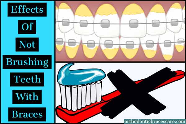Not Brushing Teeth With Braces Effects