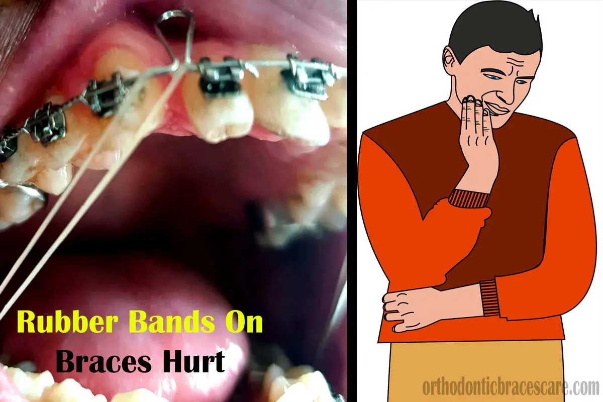 Why Do Rubber Bands On Braces Hurt So Much Orthodontic Braces Care