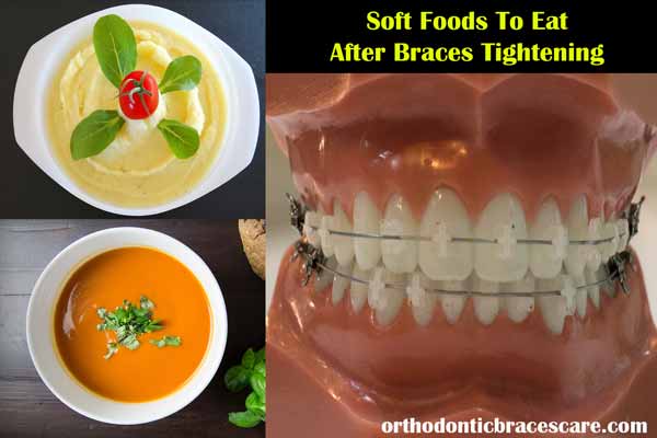 Soft Foods To Eat With Braces After Getting Tightened