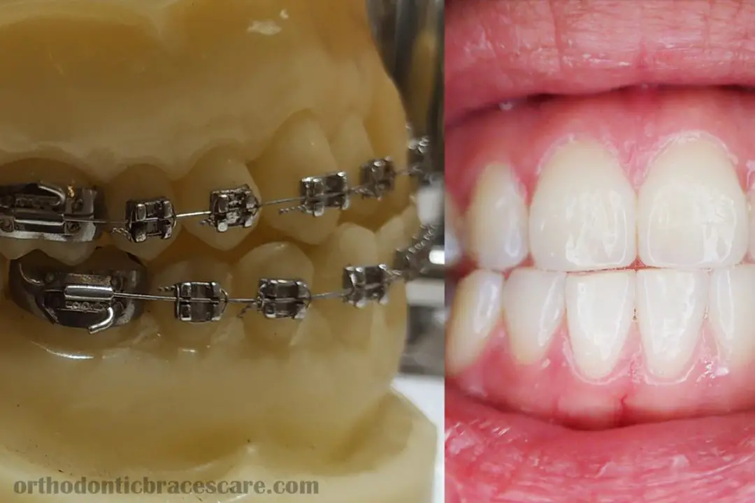 Can You Use Whitening Strips With Braces, Retainers, Invisalign