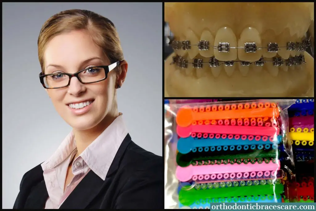 Best Braces Colors For Adults