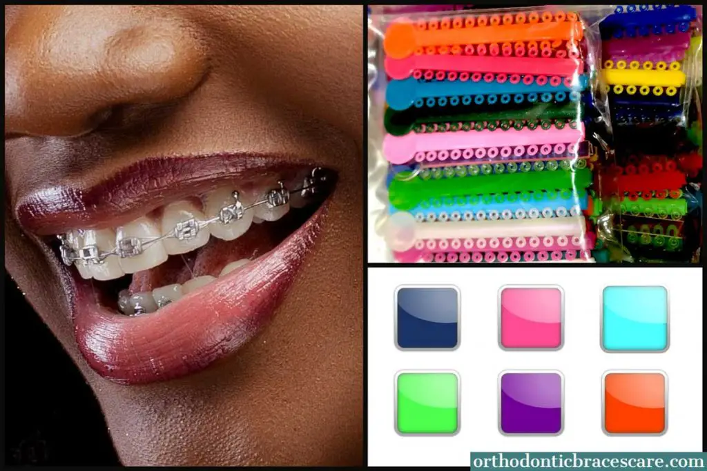 Best Braces Colors For Dark Skin How To Choose Orthodontic Braces Care 6182