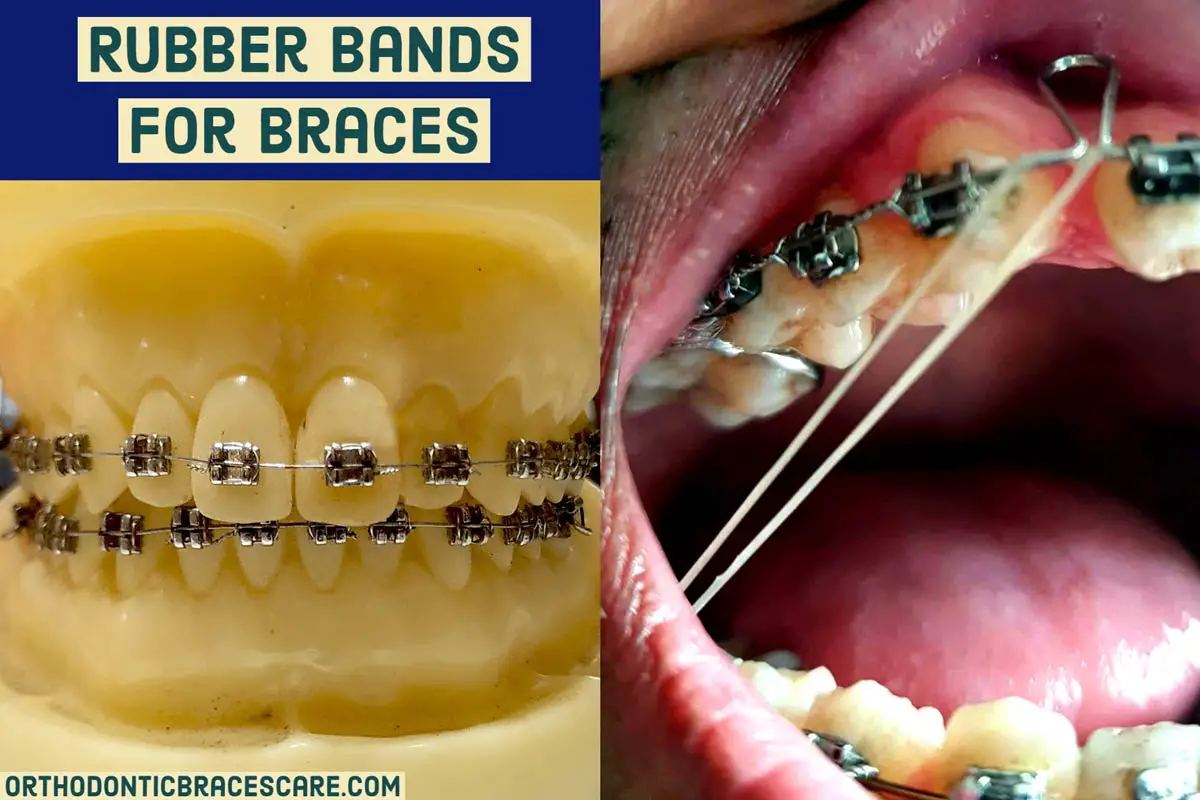 Rubber bands on braces