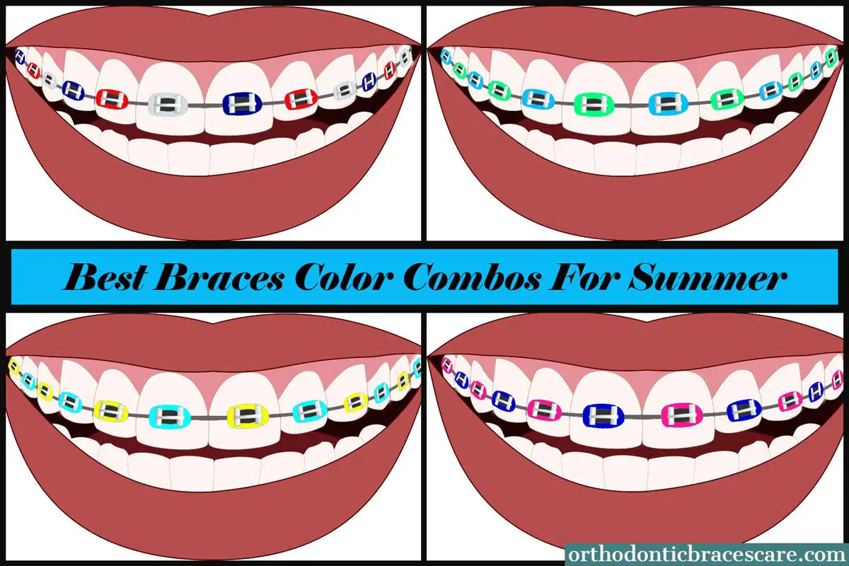 31+ Unique Braces Color Combinations for Summer 2020