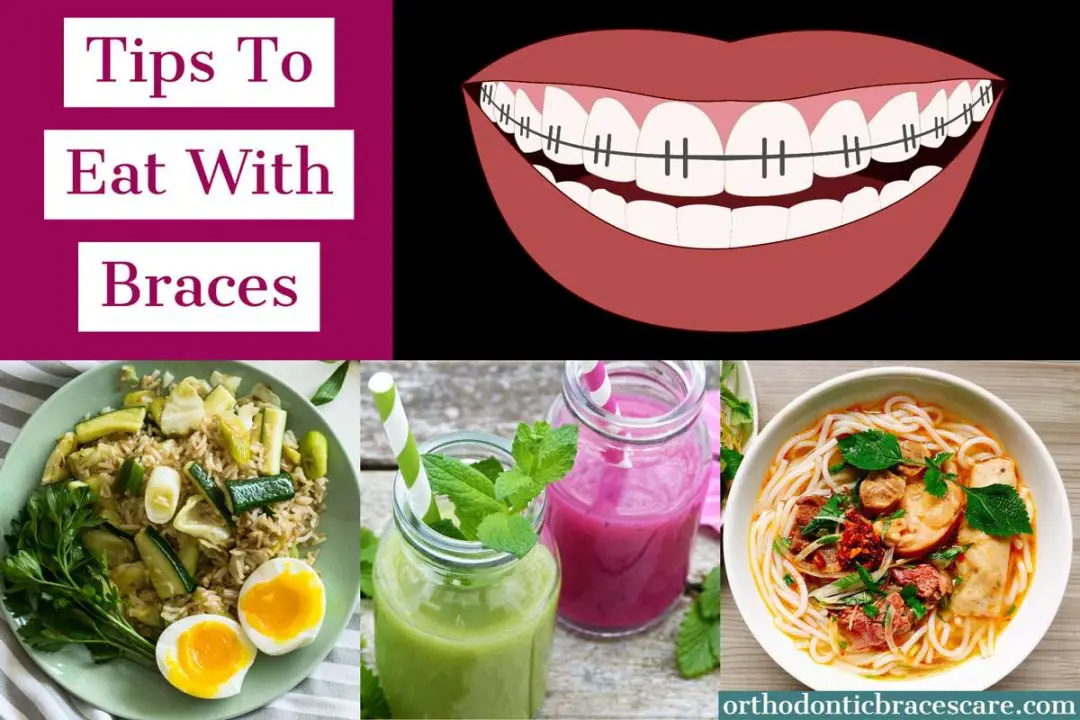 How To Eat And Chew With Braces? [Top 19 Simple Tips] - Orthodontic ...