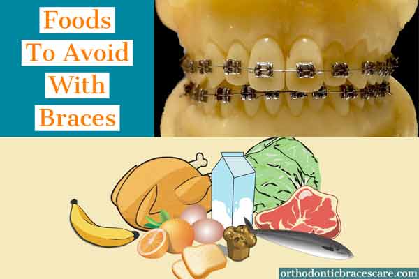 Foods to avoid with braces