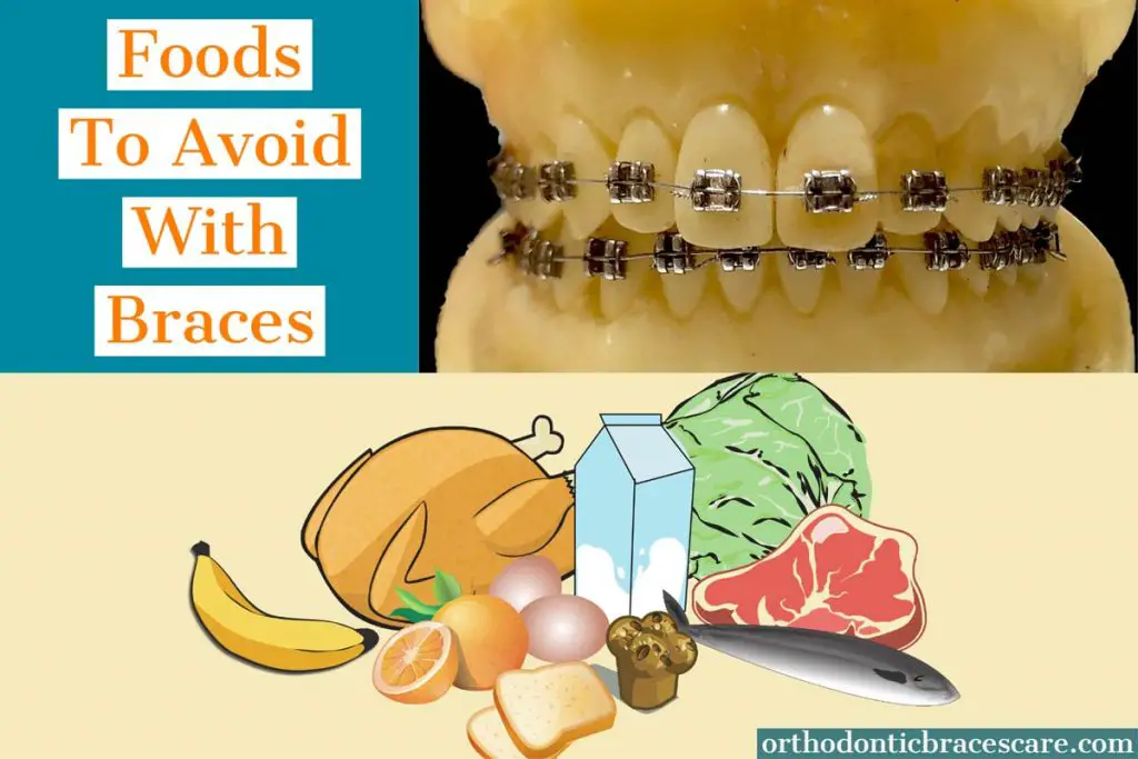 Foods to avoid or you can't eat with braces