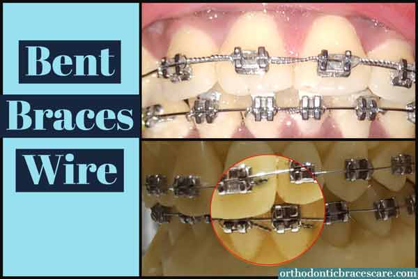 Bent braces wire