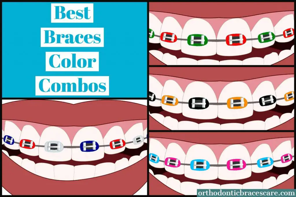 Best color combinations for braces for holidays