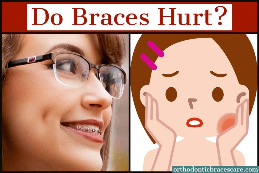 do braces hurt when you get them on