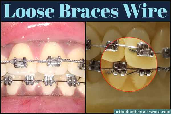 Ways To Fix Loose Wire On Braces
