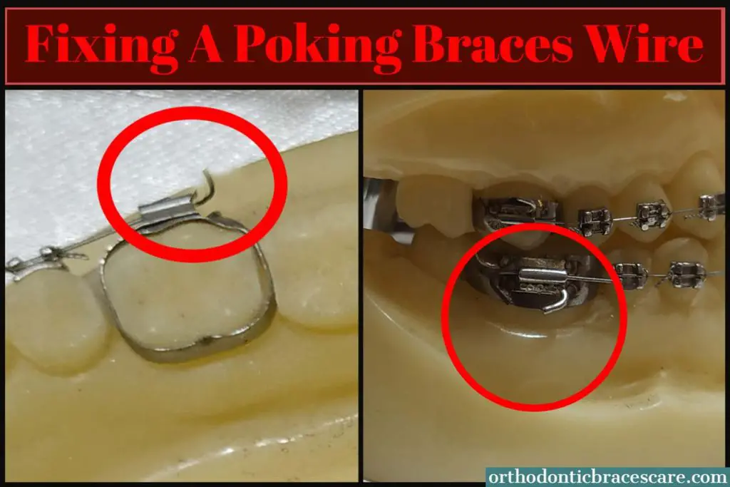 Fixing poking braces wire