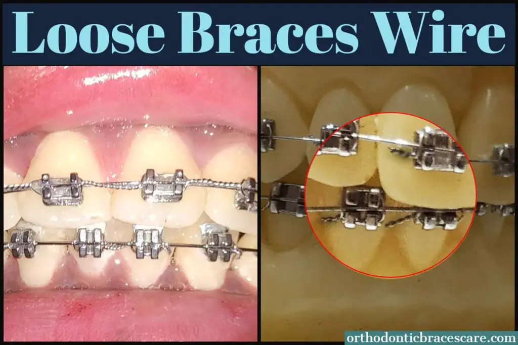 Fixing Loose Wire On Braces