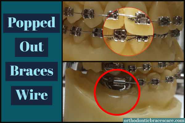 Braces Wire Popped Out Of Bracket: How To Fix
