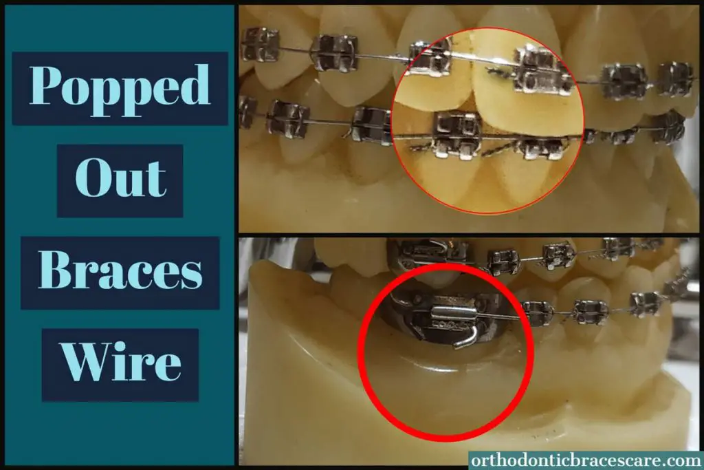 How To Fix Popped Out Braces Wire