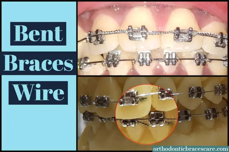 My Braces Wire Gets Bent Why This Happens, How To Fix Orthodontic